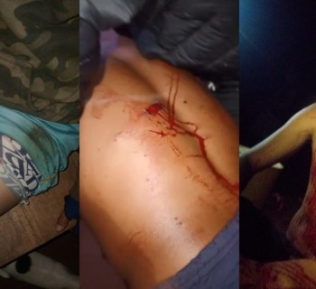 Imagens chocantes dos ferimentos causados a indígenas Avá-Guarani durante o ataque da noite de 3 de janeiro de 2025. Fotos: comunidade Avá-Guarani